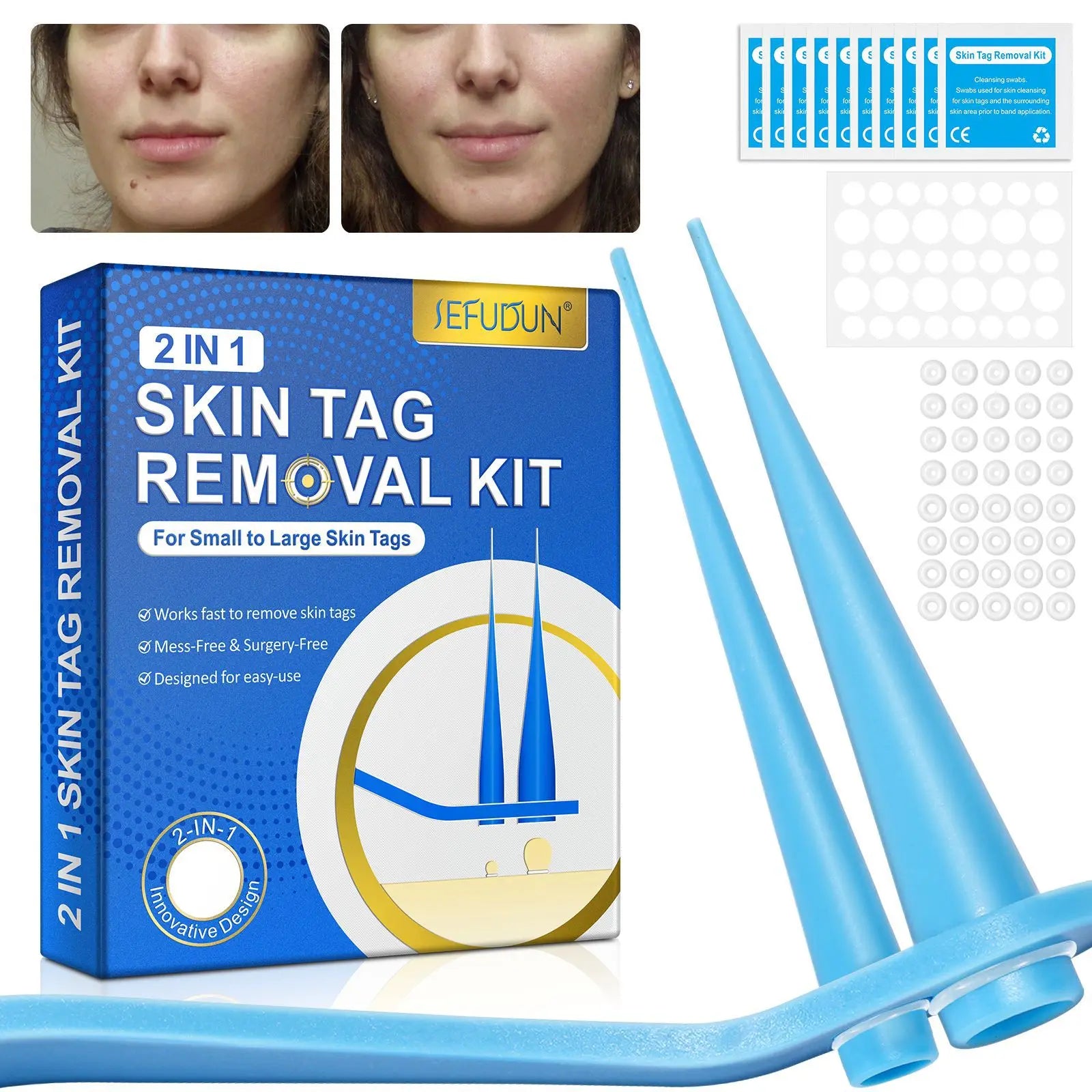 2-in-1 Auto Skin Tag & Mole Removal Kit