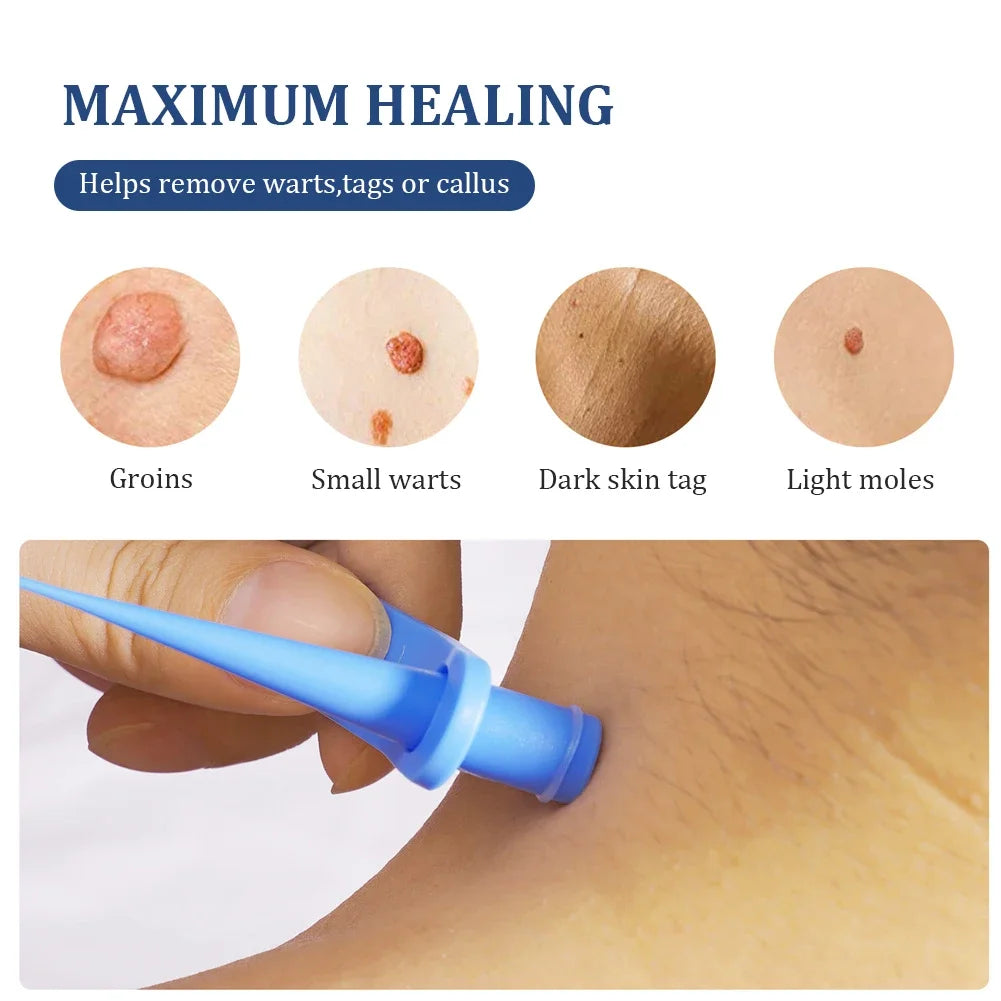 2-in-1 Auto Skin Tag & Mole Removal Kit