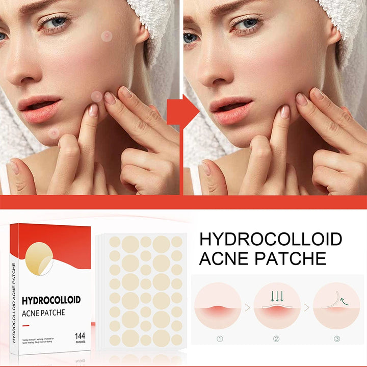 144pcs Acne Pimple Patch Set (2 Sizes)