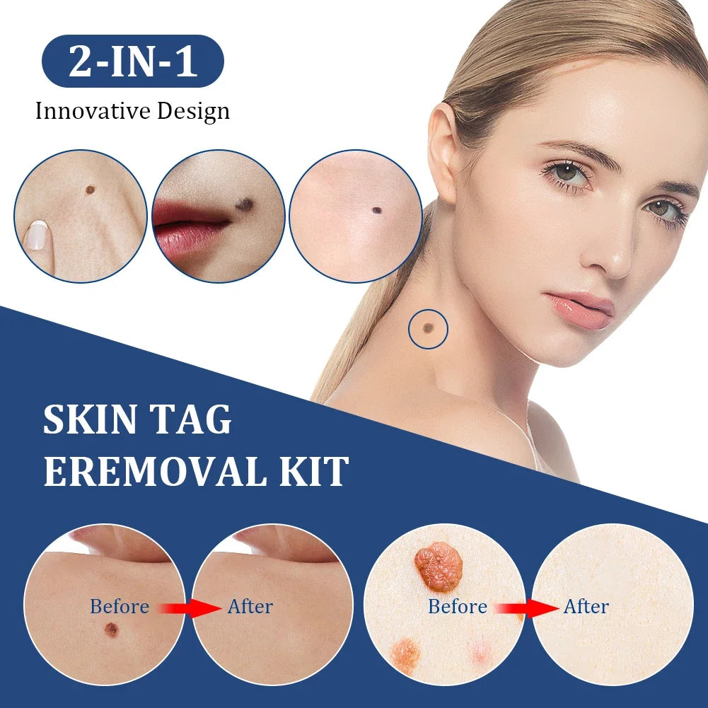 2-in-1 Auto Skin Tag & Mole Removal Kit