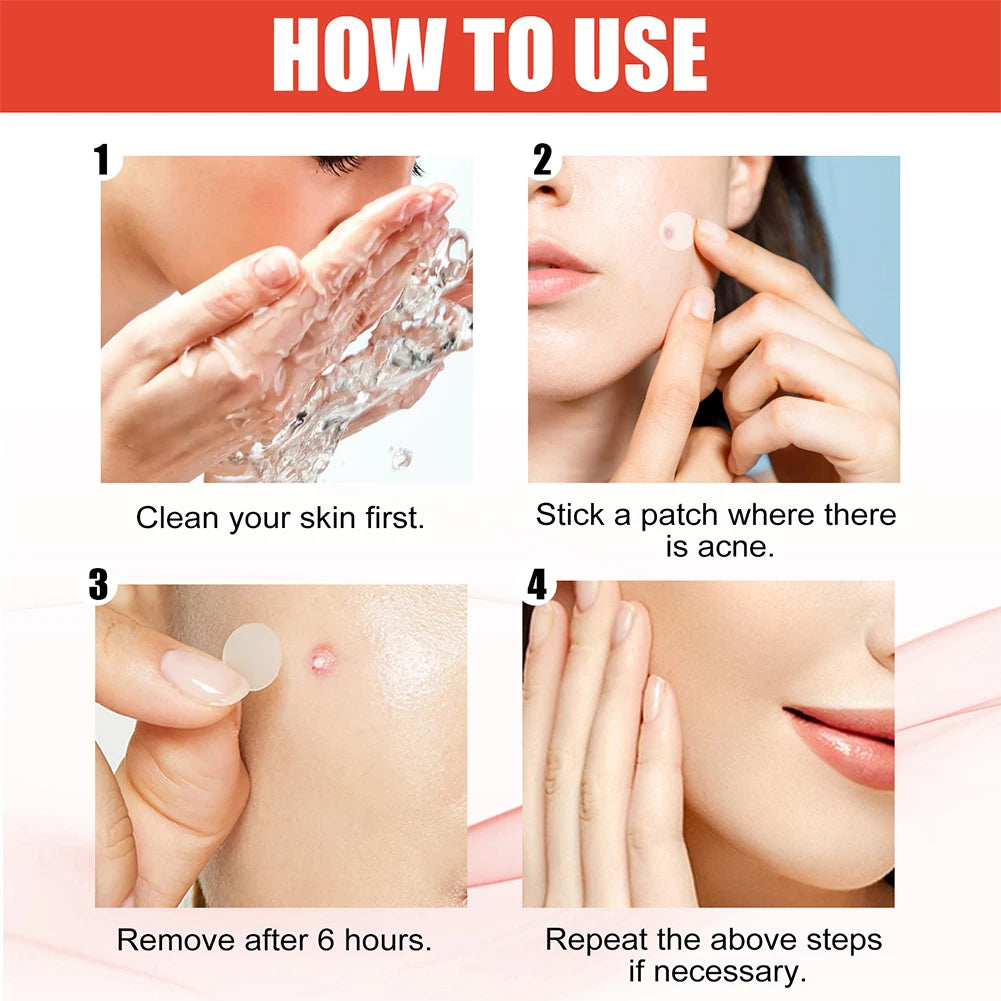 144pcs Acne Pimple Patch Set (2 Sizes)