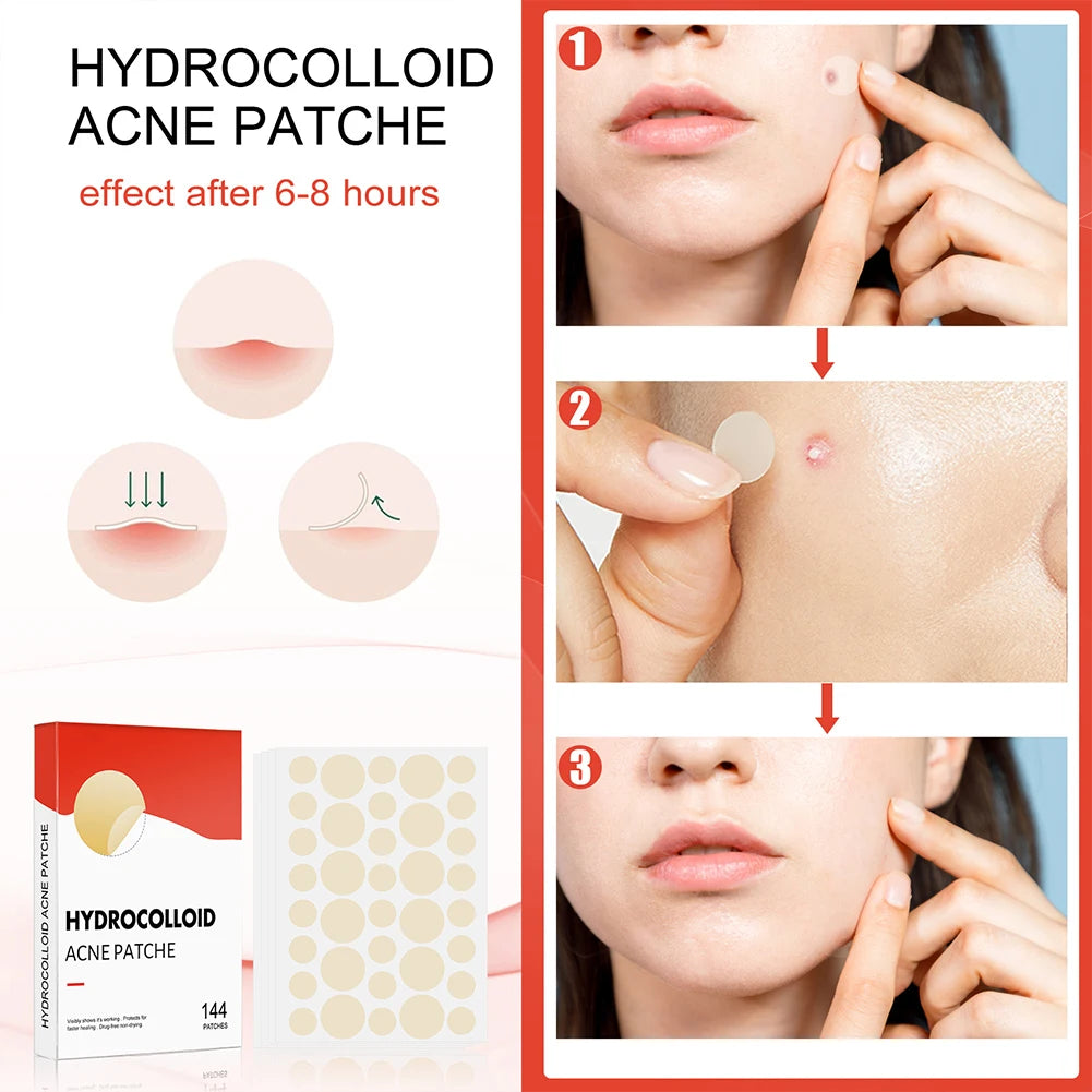144pcs Acne Pimple Patch Set (2 Sizes)